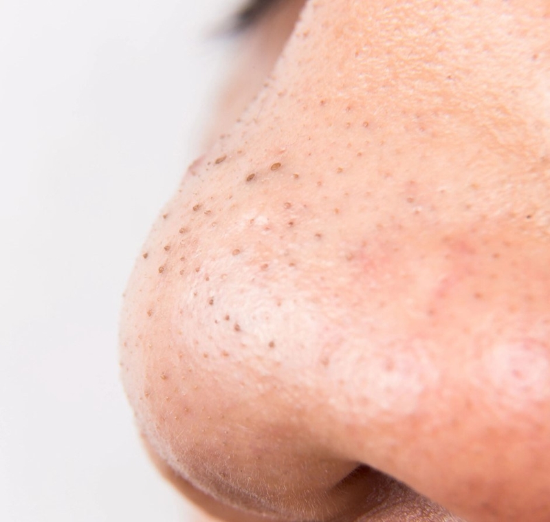 Da mụn là gì? Bạn đã biết cách chăm sóc da mụn chưa? 4