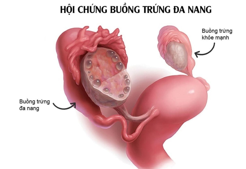 Đa nang buồng trứng gây mụn: Mối liên quan và cách điều trị 1
