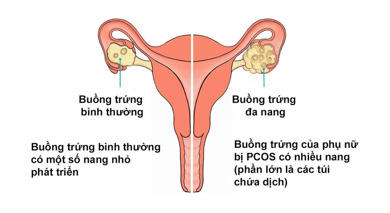 Đa nang buồng trứng gây mụn nội tiết