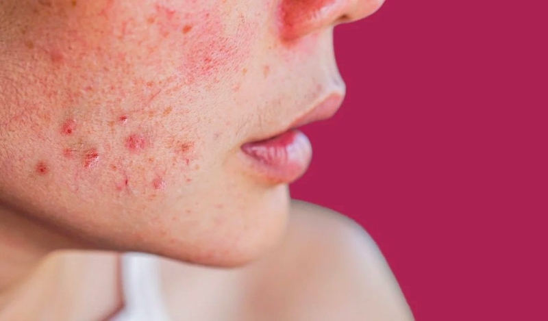 Da nhạy cảm là như thế nào? Dấu hiệu nhận biết phổ biến 1