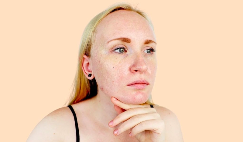 Da nhạy cảm là như thế nào? Dấu hiệu nhận biết phổ biến 3