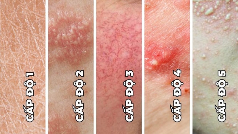 Da nhiễm corticoid có tiêm meso được không 1