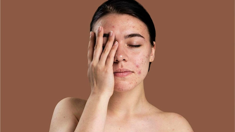 Da nhiễm corticoid có tiêm meso được không 3