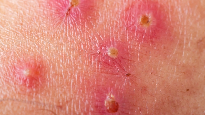 Da nổi mẩn đỏ có mủ là bệnh gì? Có nguy hiểm không? 1