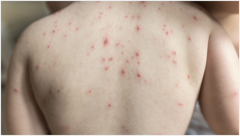 Da nổi những hạt nhỏ không ngứa là tình trạng gì? 2
