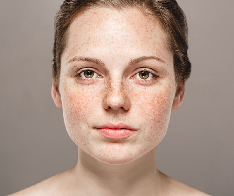 Nguyên nhân, đặc điểm và phương pháp chữa trị hiệu quả da tàn nhang lâu năm3