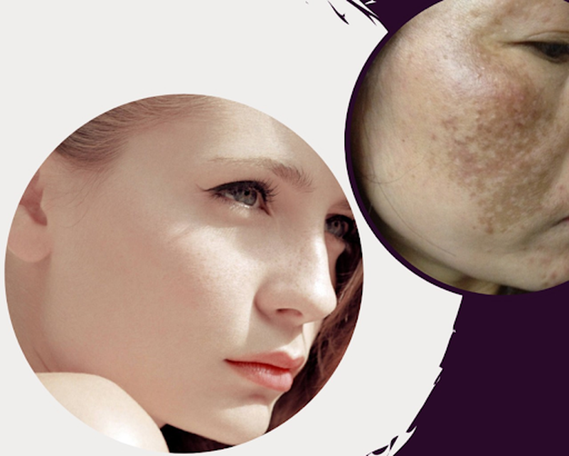 Nguyên nhân, đặc điểm và phương pháp chữa trị hiệu quả da tàn nhang lâu năm4