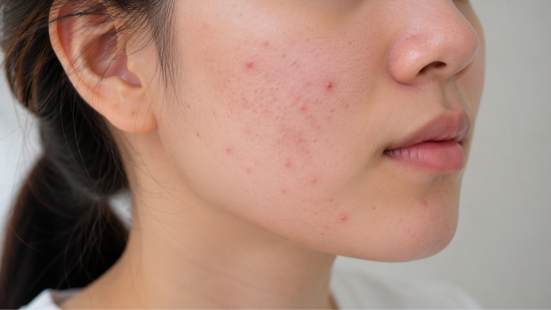 Da thường có bị nổi mụn không? Có, da thường nổi mụn do nhiều nguyên nhân