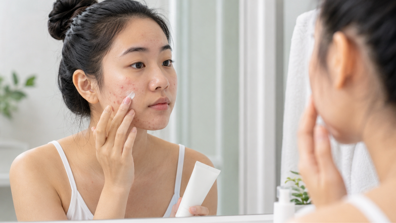 Benzoyl peroxide giúp kháng khuẩn, giảm viêm và ngăn ngừa mụn mới