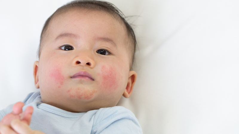 Trẻ mắc bệnh lý về da là một trong những nguyên nhân khiến da trẻ bị khô