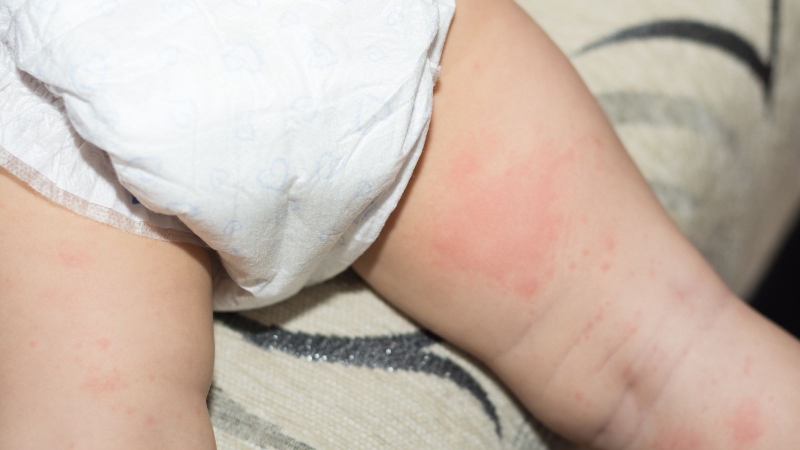 Da trẻ bị nổi sần như da gà: Nguyên nhân và phương pháp điều trị 3