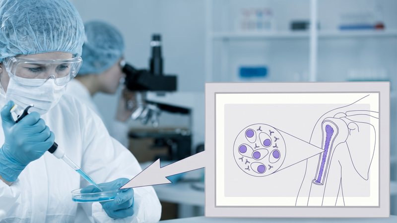 Y học hiện đại giúp bệnh đa u tủy xương được kiểm soát lâu dài