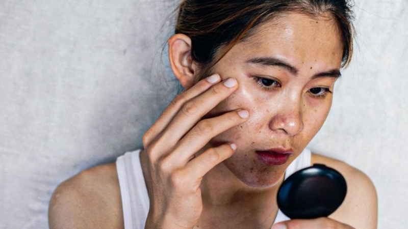 Da xỉn màu sạm đen: Nguyên nhân, cách điều trị 1