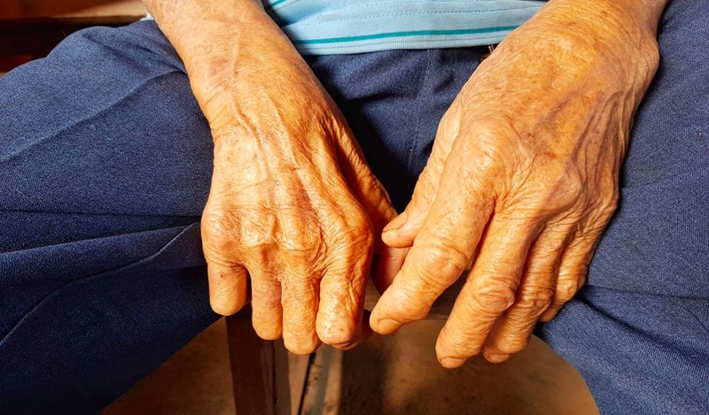 Đặc điểm của bệnh phong cùi là gì? Bệnh có lây truyền không? 1