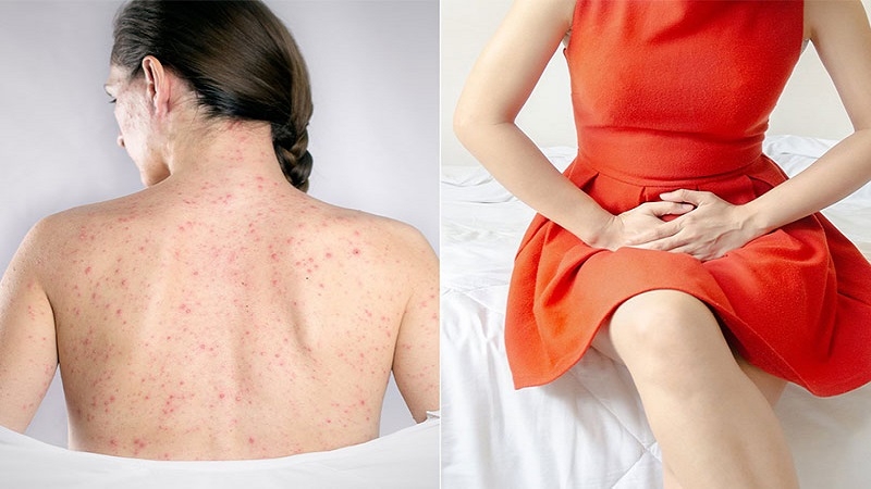 Quan hệ tình dục không an toàn là nguyên nhân phổ biến nhất gây bệnh giang mai ở phụ nữ và nam giới