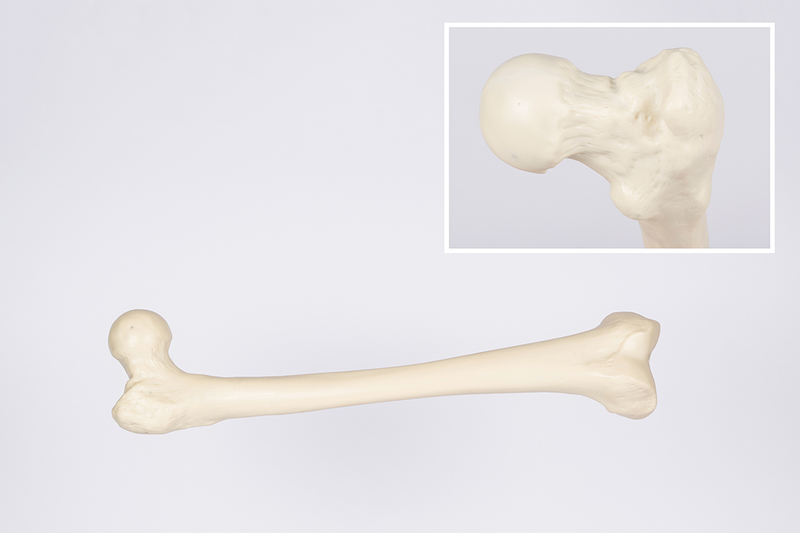 Đặc điểm giải phẫu xương đùi và các bệnh lý liên quan 5