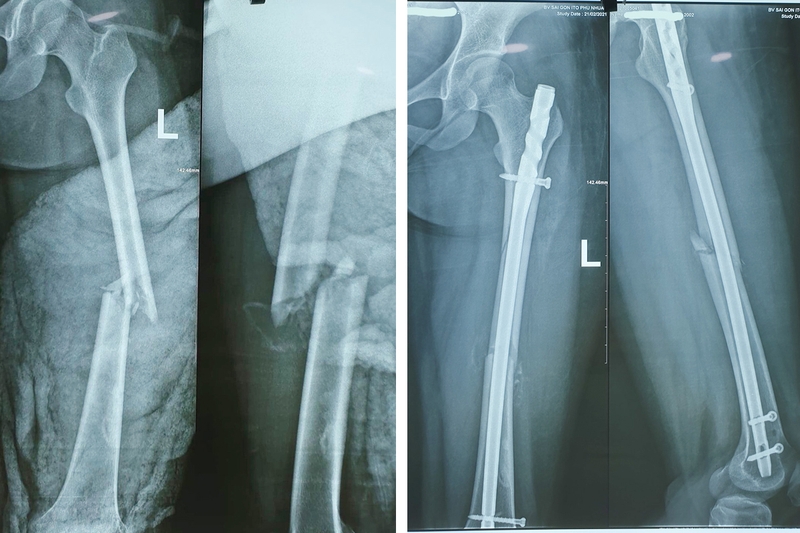 Đặc điểm giải phẫu xương đùi và các bệnh lý liên quan 4