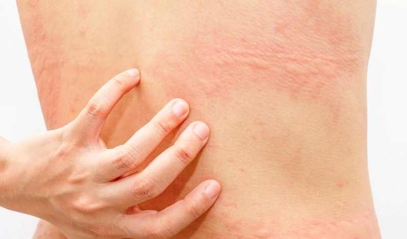 Đặc điểm nhận dạng mề đay nhiễm trùng để điều trị kịp thời 1