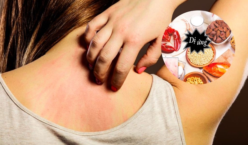 Đặc điểm nhận dạng mề đay nhiễm trùng để điều trị kịp thời 2