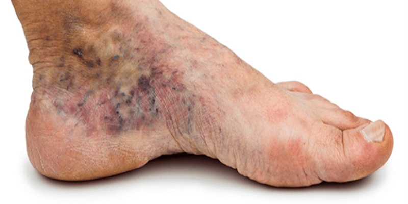 Đái tháo đường không phụ thuộc insulin: Những điều bạn cần biết 3