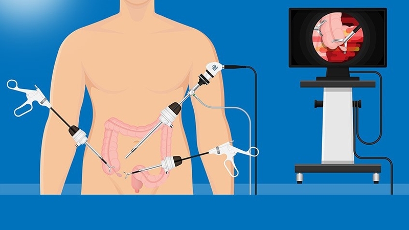 Đám quánh ruột thừa 03