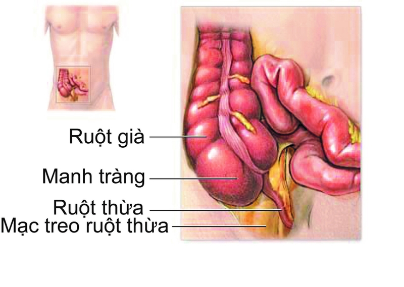Đám quánh ruột thừa là gì? - Biến chứng của viêm ruột thừa cấp 4