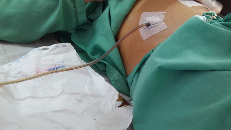 Dẫn lưu là gì? Cách chăm sóc cho người bệnh sử dụng ống dẫn lưu 0