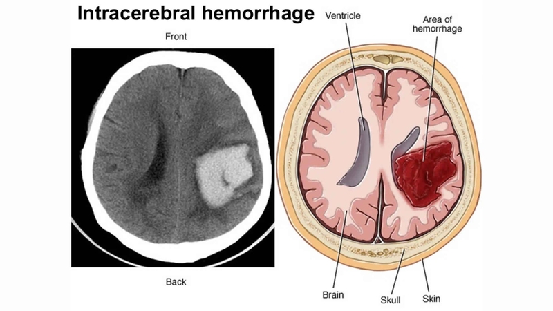 Dẫn lưu não thất được thực hiện khi nào? Quy trình phẫu thuật dẫn lưu não thất 2