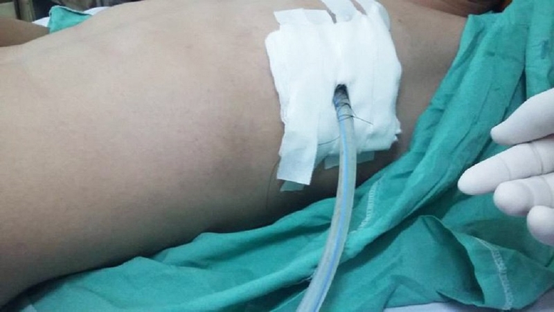 Dẫn lưu túi mật xuyên gan qua da là thế nào? Quy trình thực hiện ra sao? 4