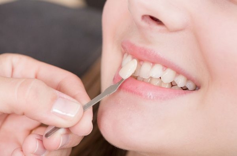 Dán răng sứ liệu có mang lại hiệu quả tốt hay không? 1