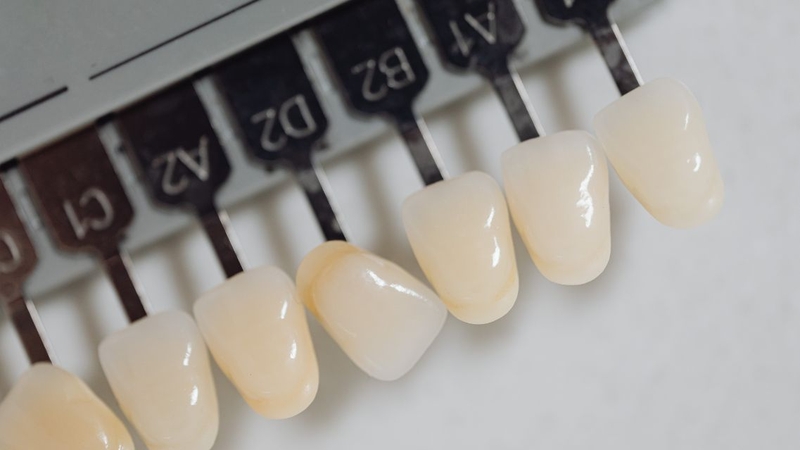 Dán sứ Veneer giá bao nhiêu 1 răng&nbsp;tùy thuộc từng dòng sứ