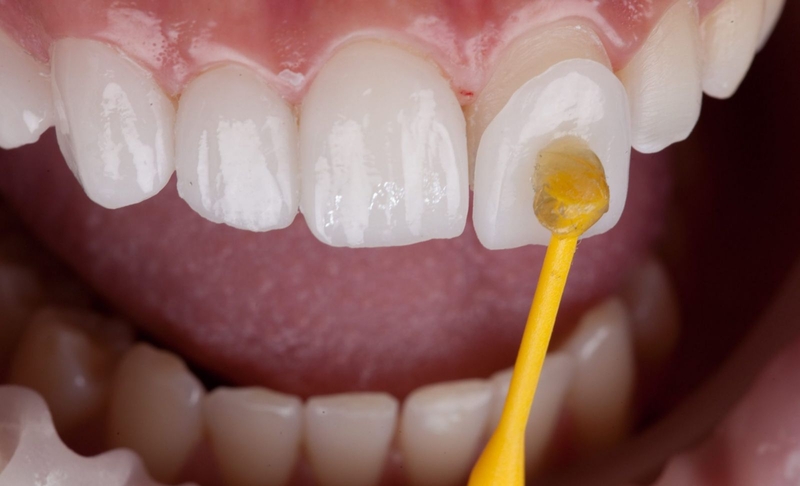 Dán veneer có niềng răng được không? Dán veneer hay bọc sứ tốt hơn? 1
