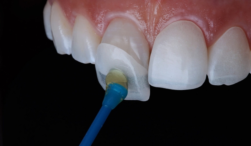 Dán veneer có phải mài răng không? Ưu nhược điểm của dán sứ veneer? 3