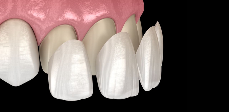 Dán veneer được bao lâu? Yếu tố ảnh hưởng đến tuổi thọ của mặt dán sứ? 1