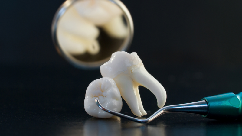 Nhổ răng khôn bằng sóng siêu âm (Piezosurgery) cho mẹ đang cho con bú