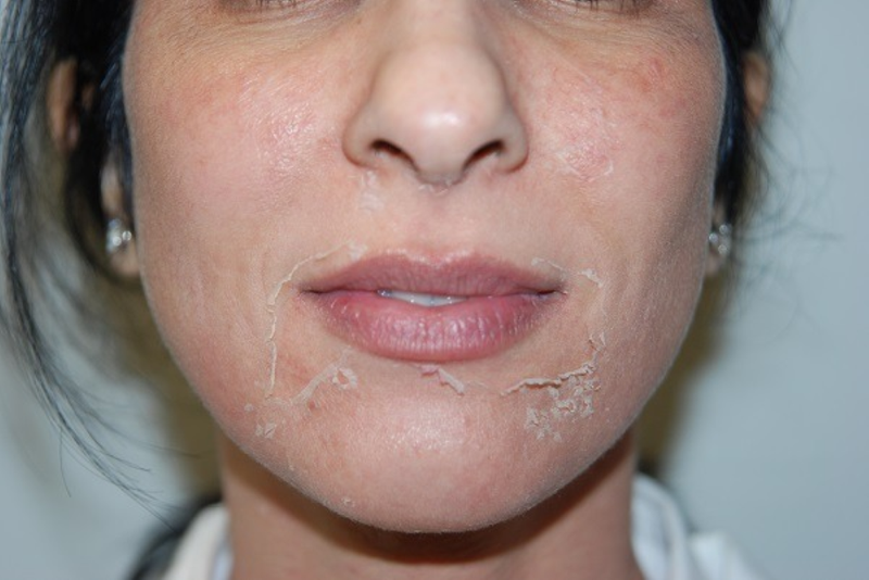 Đang peel da có được make up không? 3