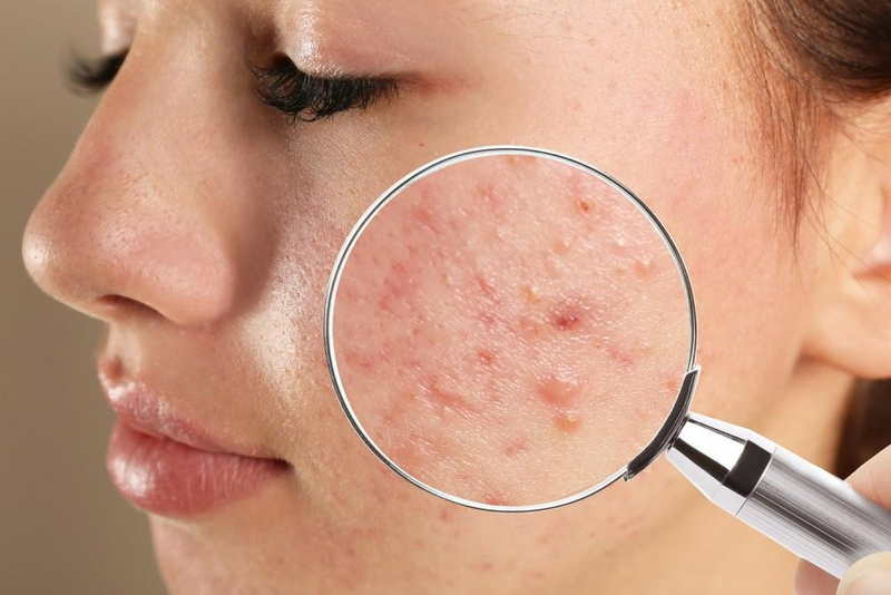 Đánh bay nốt mụn trứng cá khó ưa với miếng dán mụn dermaAngel1