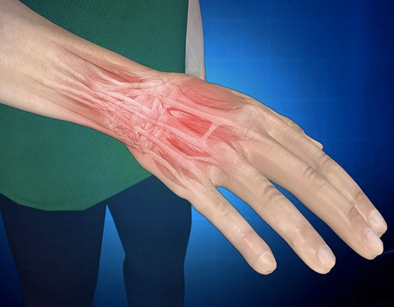 Đánh cầu lông bị đau tay: Nguyên nhân, cách phòng tránh 2