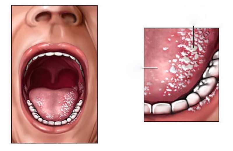 Danh sách những bệnh ở lưỡi nguy hiểm mà bạn cần biết
