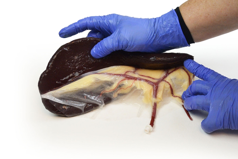 Dập lá lách cấp độ 3: Nguyên nhân, cách điều trị và thời gian phục hồi 3