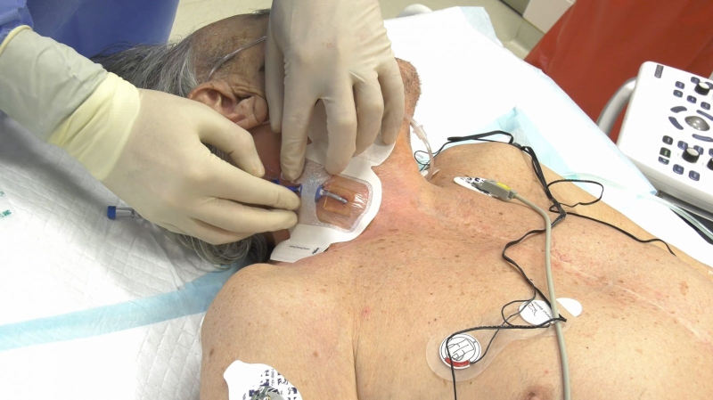 Đặt catheter tĩnh mạch trung tâm có ưu điểm gì 1