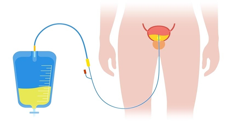 Đặt ống thông tiểu có làm rách màng trinh không?