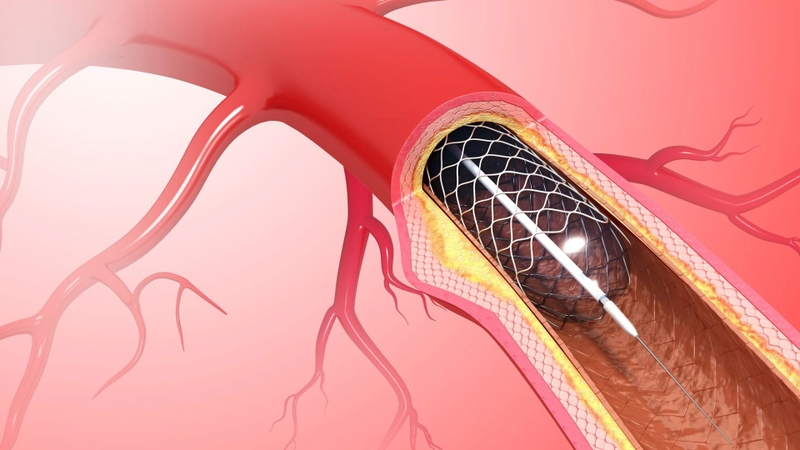Đặt stent tim là gì? Những điều cần biết về quy trình đặt stent tim 1