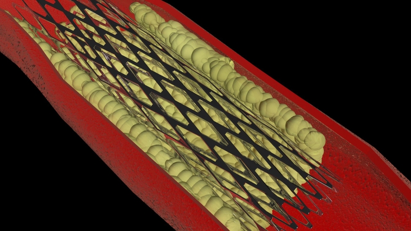 Đặt stent tim là gì? Những điều cần biết về quy trình đặt stent tim 2