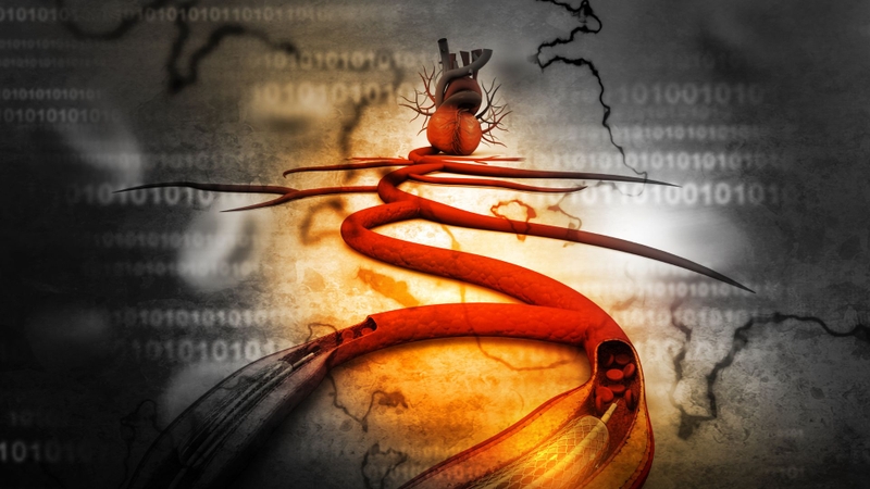 Đặt stent tim là gì? Những điều cần biết về quy trình đặt stent tim 3