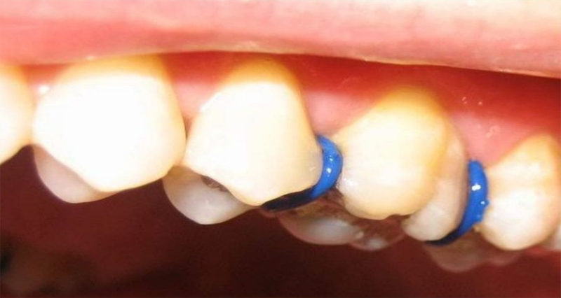 Đặt thun tách kẽ răng để làm gì? Có đau không? Mất bao lâu? 1