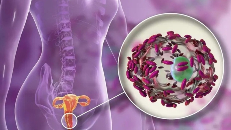 Nhiễm trùng phụ khoa gây ra máu khi quan hệ tình dục sau đặt vòng