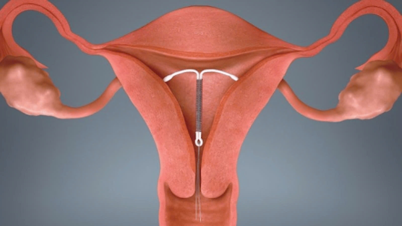 Đặt vòng tránh thai có được chụp MRI không? Những điều cần biết 1