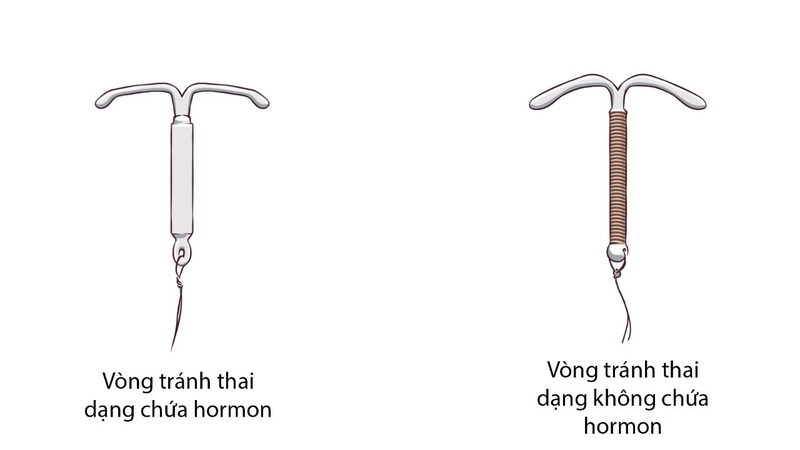 Đặt vòng tránh thai có tăng cân không, có nên tháo khi tăng cân 1
