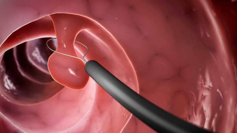 Đau bụng sau khi cắt polyp đại tràng có sao không?